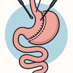Bariatric Surgery (Gastric bypass/sleeve) procedure thumbnail