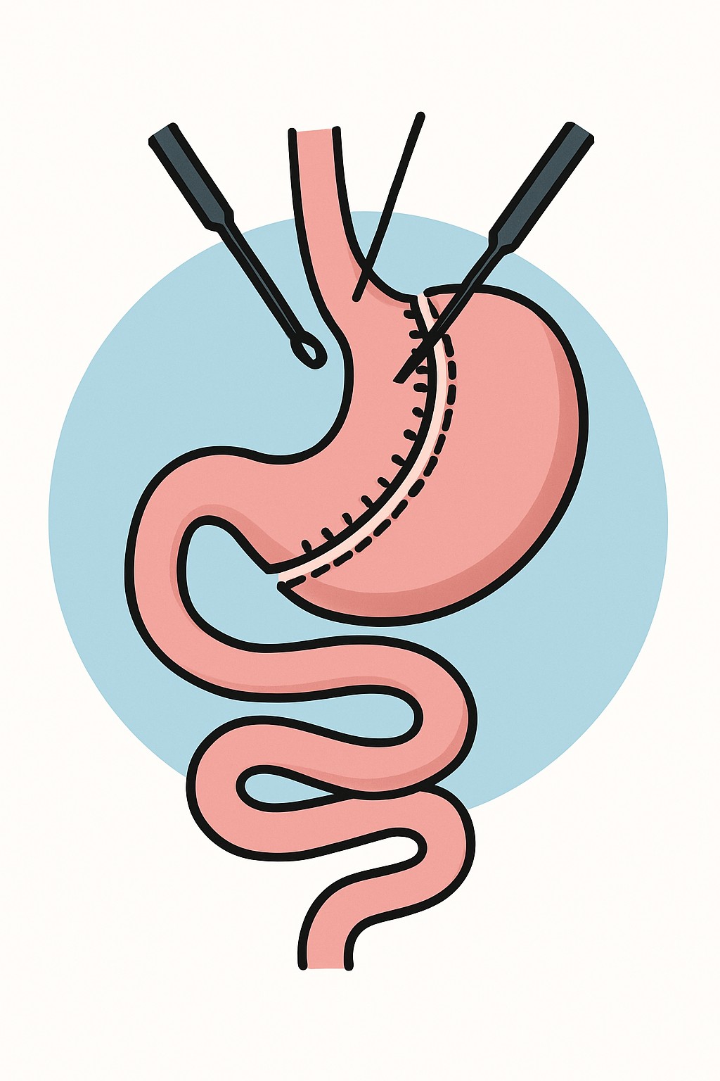Bariatric Surgery (Gastric bypass/sleeve) procedure illustration