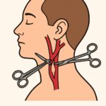 Carotid Endarterectomy procedure thumbnail