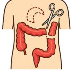 Colectomy (Partial colon resection) procedure thumbnail