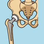 Hip Replacement (Total Hip Arthroplasty) procedure thumbnail