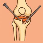 Knee Arthroscopy (Meniscectomy) procedure thumbnail