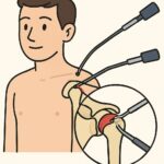 Shoulder Arthroscopy (Rotator cuff repair) procedure thumbnail