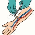 Aseptic surgical procedure illustrating hand surgery, blood vessels, and surgical tools for medical, healthcare, and surgical training purposes.