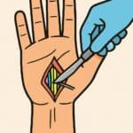 Medical procedure illustration of a hand, with a surgical incision being treated using a scalpel or cautery tool in a healthcare setting, emphasizing safe surgical practices.
