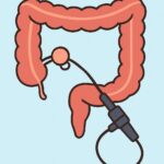 Colonoscopy with polyp removal procedure thumbnail