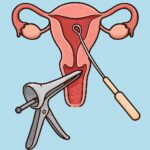 Dilation and curettage (endometrial tissue sampling) procedure thumbnail