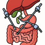 Gallbladder removal (laparoscopic cholecystectomy) procedure thumbnail