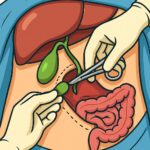 Gallbladder removal – open surgery procedure thumbnail