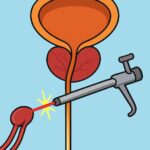 Holmium Laser Prostate Enucleation (HoLEP) procedure thumbnail