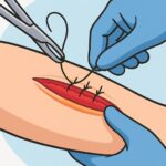 Intermediate wound repair (layered closure – small) procedure thumbnail