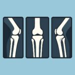Knee X-ray (3 views) procedure thumbnail