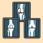 Knee X-ray (3 views knee series) procedure thumbnail
