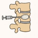 Kyphoplasty (Vertebral augmentation) procedure thumbnail