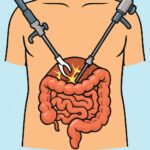 Laparoscopic adhesiolysis (bowel obstruction relief) procedure thumbnail
