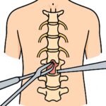 Lumbar laminectomy (spinal decompression) procedure thumbnail