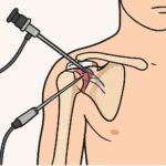 Shoulder arthroscopy with rotator cuff repair procedure thumbnail