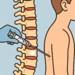 Thoracic vertebroplasty (spine cement injection) procedure thumbnail